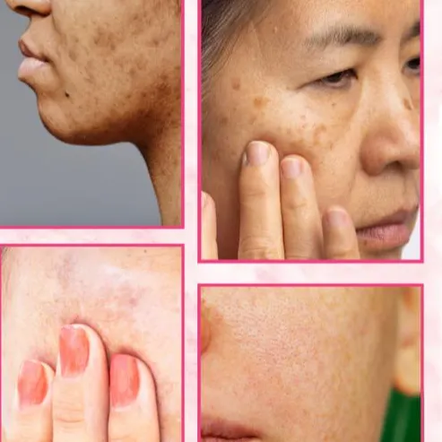 What Are the Best Ingredients for Removing Pigmentation? A Deep Dive